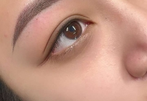 Mí mở tròng là gì ? Tìm hiểu về mí mở tròng
