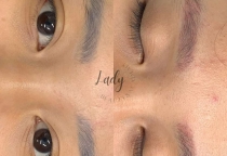 Xóa laser là gì? Xóa laser có đau không?