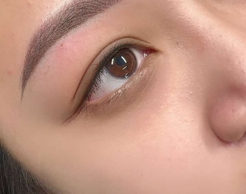 Mí mở tròng là gì ? Tìm hiểu về mí mở tròng