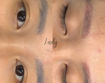 Xóa laser là gì? Xóa laser có đau không?