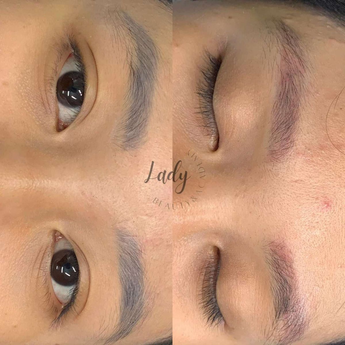 xóa laser tại Lady Beauty Academy Quận 6
